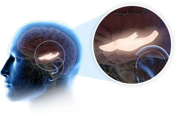 Illustration of sound waves travelling into the brain and reaching the inner brain structures